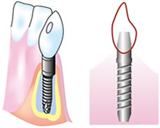 インプラント