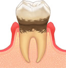 歯肉炎(軽度)